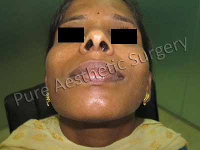 Autologous Fat Grafting 2