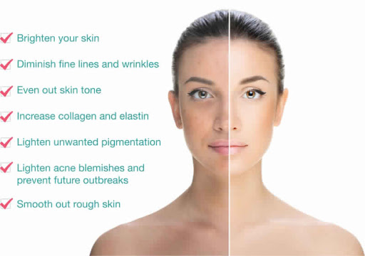 chemical-peel