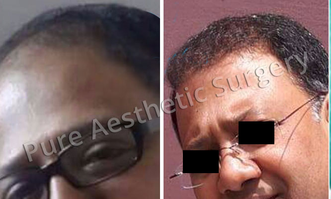 Man Hair Transplant 8