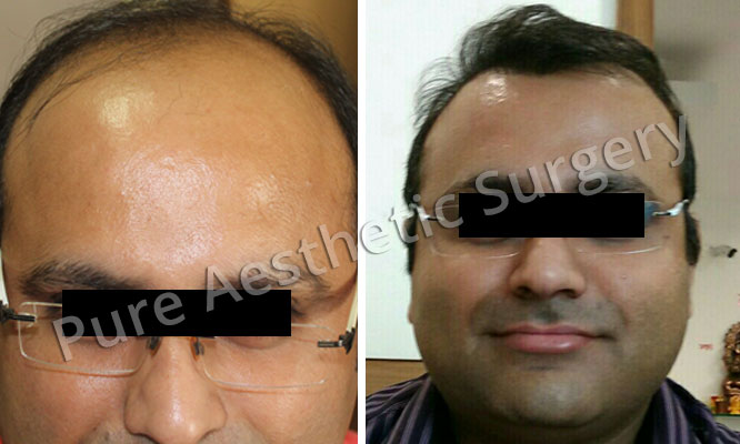 Man Hair Transplant 10