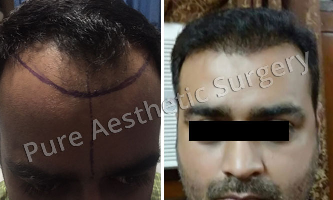 Man Hair Transplant 11