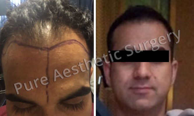Man Hair Transplant 13