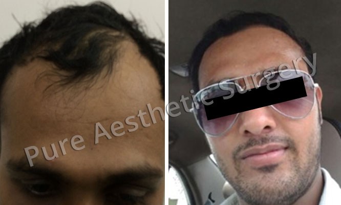 Man Hair Transplant 14