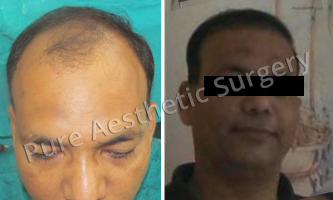 Man Hair Transplant 15