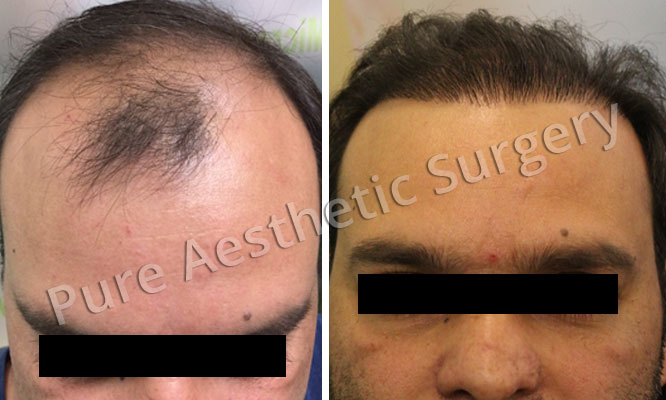 Man Hair Transplant 16