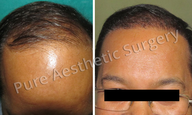 Man Hair Transplant 17