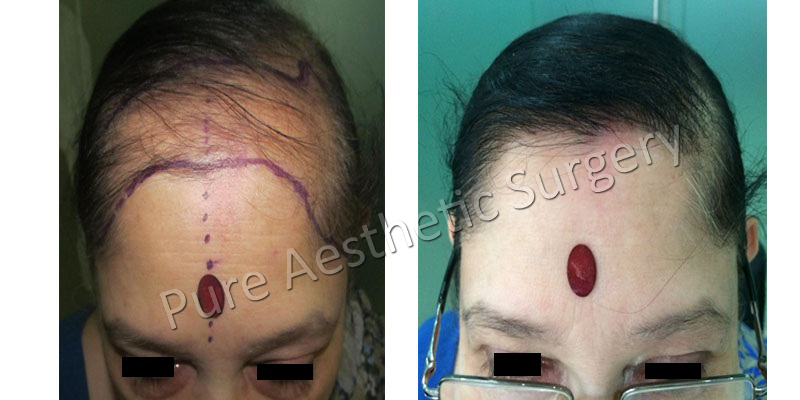 Woman Hair Transplant 1