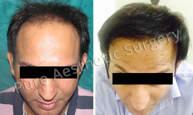 Man Hair Transplant 18