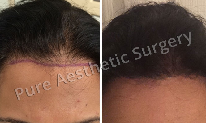 Woman Hair Transplant 2