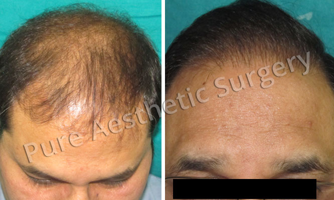 Man Hair Transplant 4