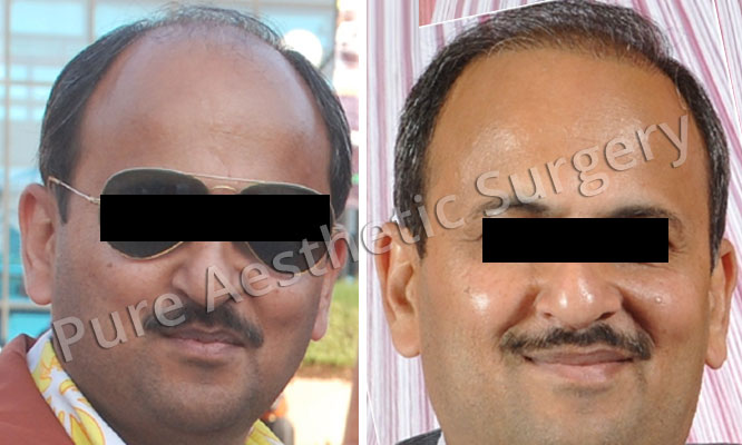 Man Hair Transplant 6
