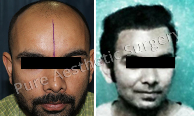 Man Hair Transplant 7